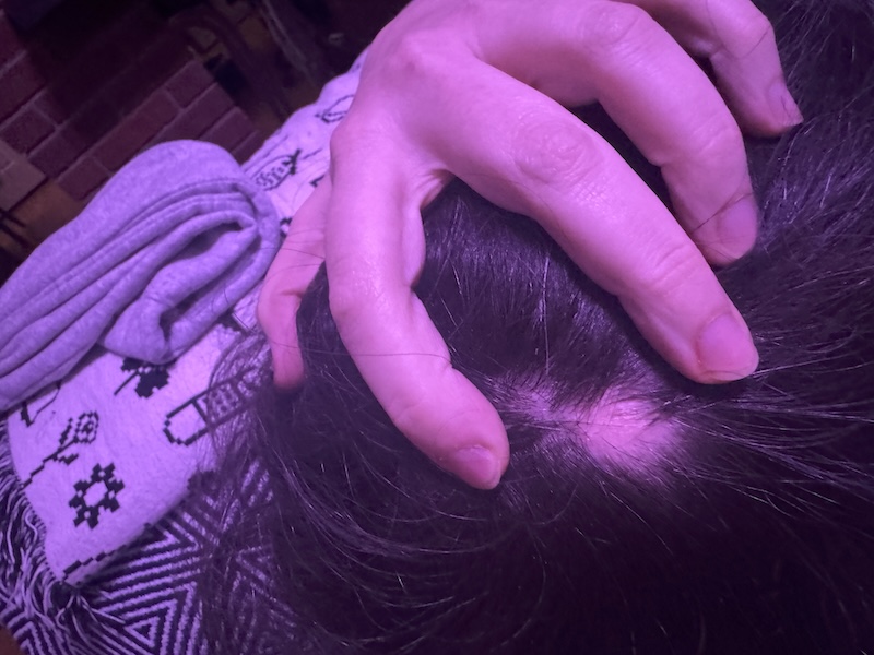 photo of a dime-sized bald spot on the back of my head