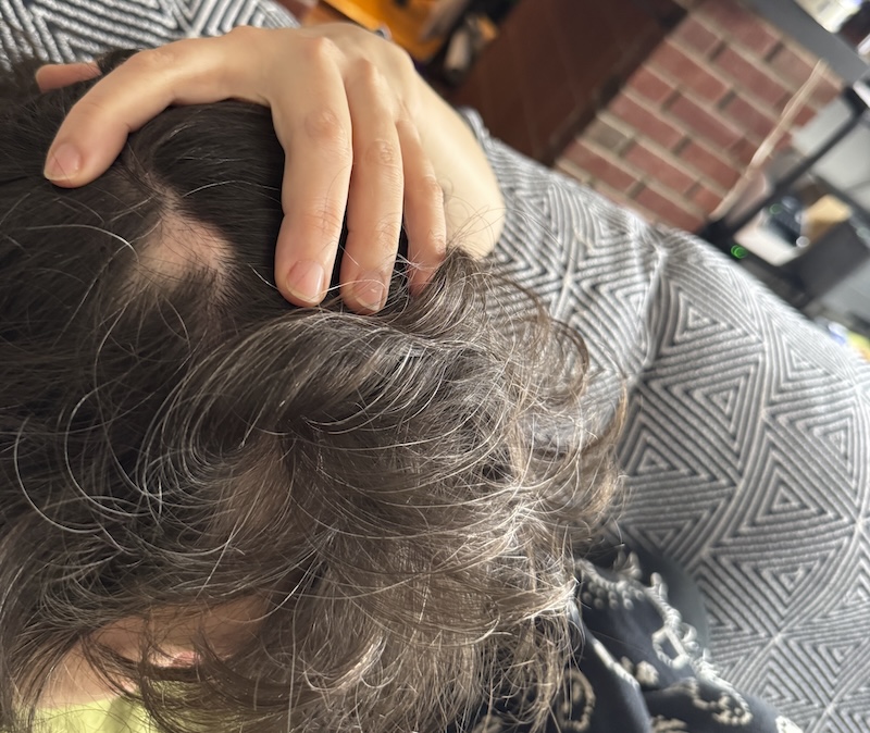 photo i took of the back side of my head by holding my arm up and around so it's framed poorly but there is a 3-square corner tetris piece-shaped bald spot on my head